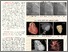 [thumbnail of ALCAPA (Anomalous Left Coronary Artery from the Pulmonary Artery) SYN DROME  A CASE REPORT(1).pdf]