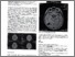 [thumbnail of Intracerebral hemorrhage in an eight year old girl Eur J Pediatr (2019)-1.pdf]